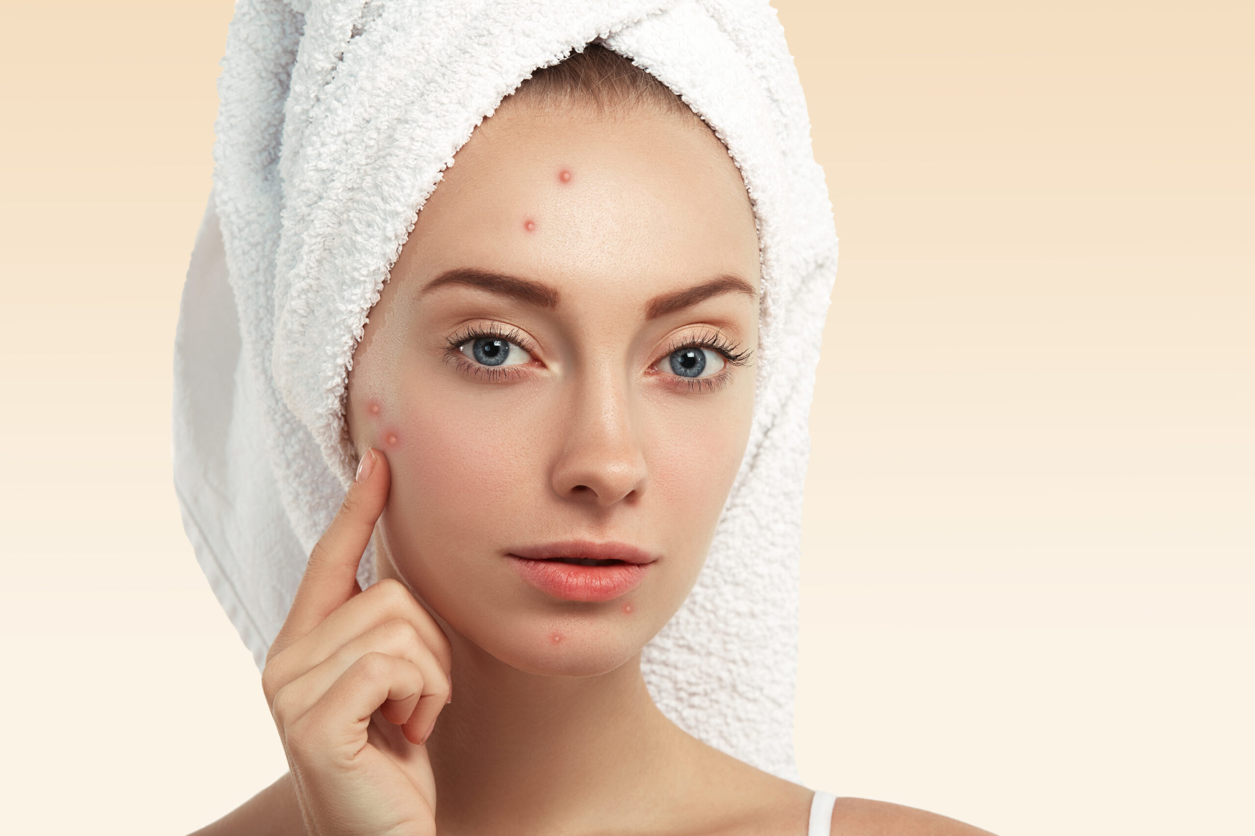 fade acne scars naturally